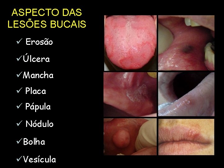 ASPECTO DAS LESÕES BUCAIS ü Erosão üÚlcera üMancha ü Placa ü Pápula ü Nódulo ASPECTO DAS LESÕES BUCAIS ü Erosão üÚlcera üMancha ü Placa ü Pápula ü Nódulo