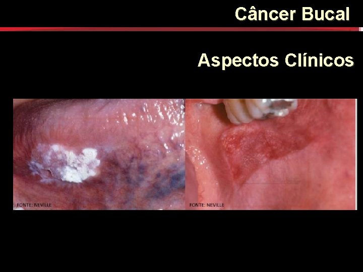 Câncer Bucal Aspectos Clínicos Câncer Bucal Aspectos Clínicos