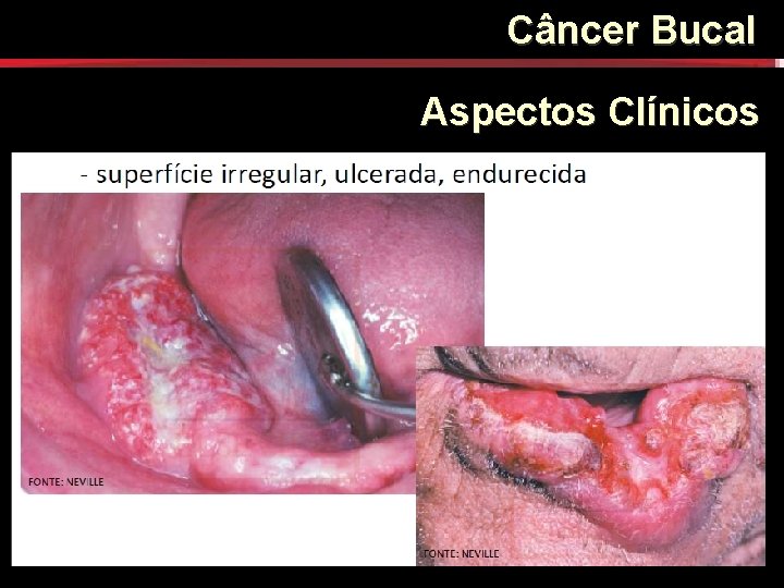 Câncer Bucal Aspectos Clínicos Câncer Bucal Aspectos Clínicos