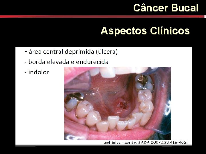 Câncer Bucal Aspectos Clínicos Câncer Bucal Aspectos Clínicos