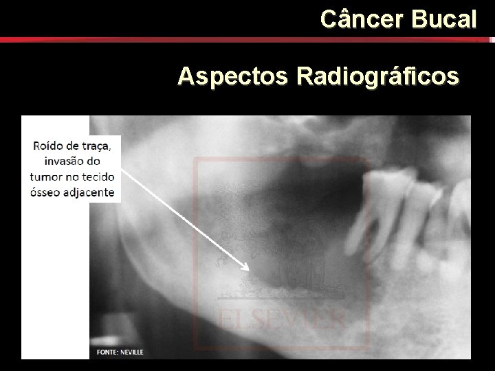 Câncer Bucal Aspectos Radiográficos Câncer Bucal Aspectos Radiográficos