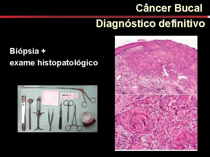 Câncer Bucal Diagnóstico definitivo Biópsia + exame histopatológico Câncer Bucal Diagnóstico definitivo Biópsia + exame histopatológico