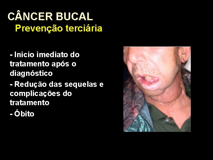 C NCER BUCAL Prevenção terciária - Inicio imediato do tratamento após o diagnóstico - C NCER BUCAL Prevenção terciária - Inicio imediato do tratamento após o diagnóstico -