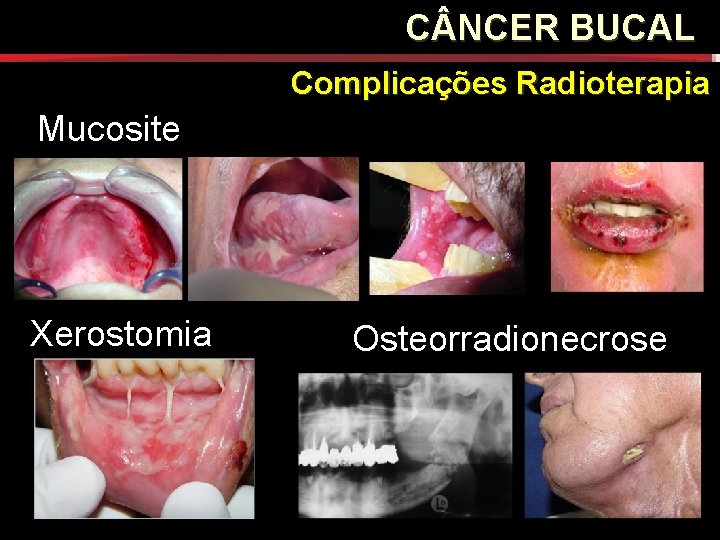 C NCER BUCAL Complicações Radioterapia Mucosite Xerostomia Osteorradionecrose C NCER BUCAL Complicações Radioterapia Mucosite Xerostomia Osteorradionecrose