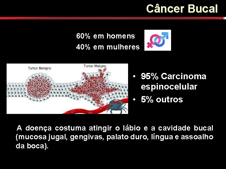 Câncer Bucal C NCER BUCAL 60% em homens 40% em mulheres • 95% Carcinoma Câncer Bucal C NCER BUCAL 60% em homens 40% em mulheres • 95% Carcinoma