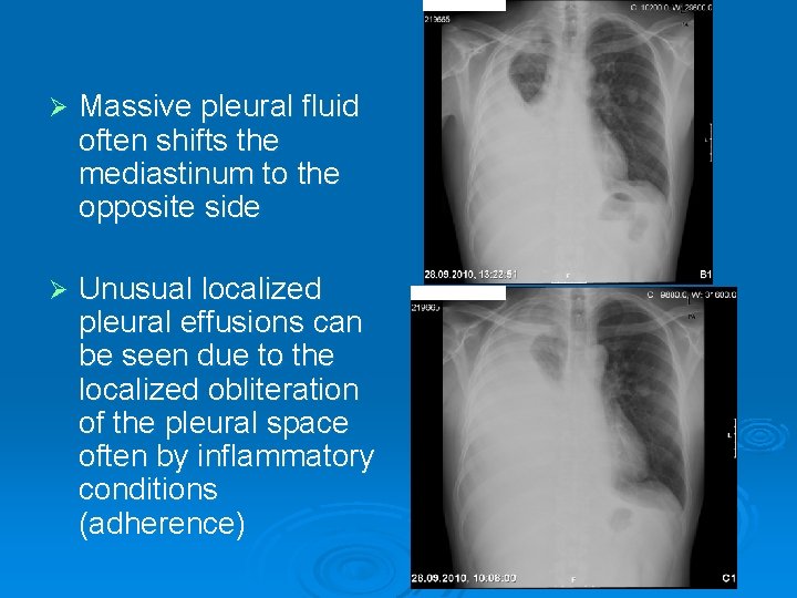 Ø Massive pleural fluid often shifts the mediastinum to the opposite side Ø Unusual