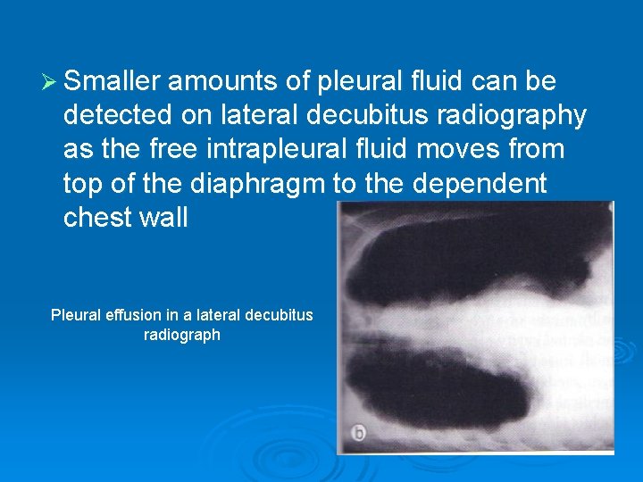 Ø Smaller amounts of pleural fluid can be detected on lateral decubitus radiography as