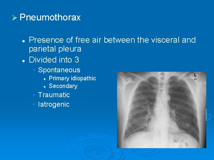 Ø Pneumothorax l l Presence of free air between the visceral and parietal pleura