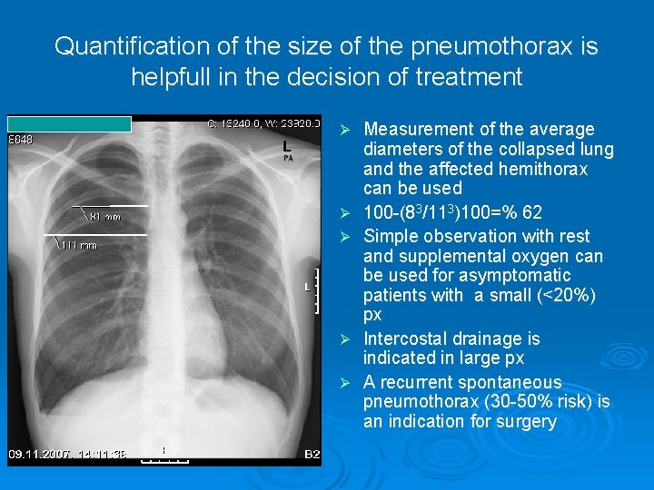 Quantification of the size of the pneumothorax is helpfull in the decision of treatment