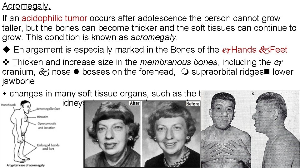 Acromegaly. If an acidophilic tumor occurs after adolescence the person cannot grow taller, but Acromegaly. If an acidophilic tumor occurs after adolescence the person cannot grow taller, but