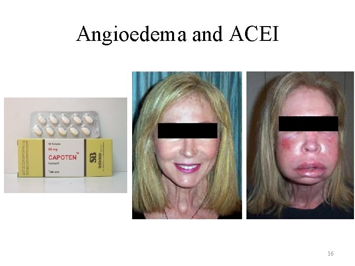Angioedema and ACEI 16 Angioedema and ACEI 16