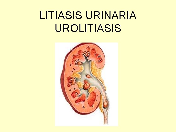 LITIASIS URINARIA UROLITIASIS 