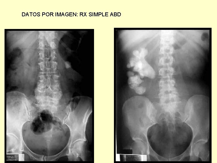 DATOS POR IMAGEN: RX SIMPLE ABD 