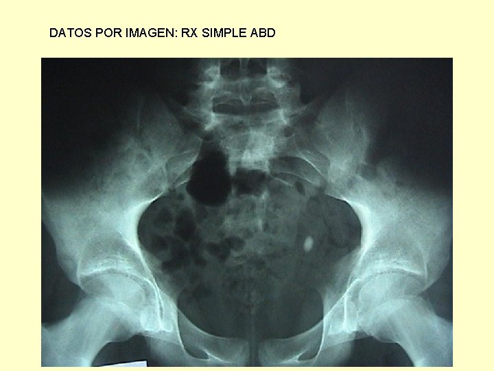 DATOS POR IMAGEN: RX SIMPLE ABD DATOS POR IMAGEN: RX SIMPLE ABD