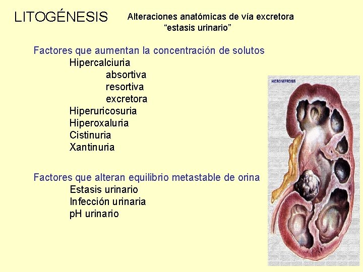 LITOGÉNESIS Alteraciones anatómicas de vía excretora “estasis urinario” Factores que aumentan la concentración de