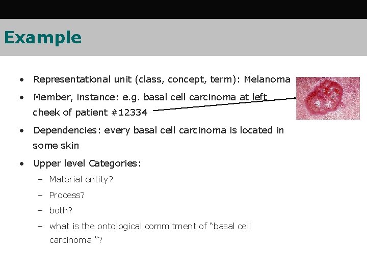 Example • Representational unit (class, concept, term): Melanoma • Member, instance: e. g. basal
