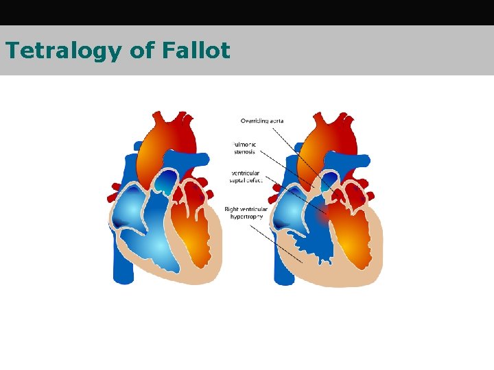 Tetralogy of Fallot 