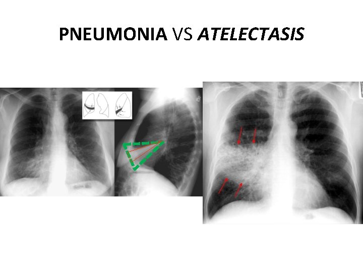 PNEUMONIA VS ATELECTASIS 