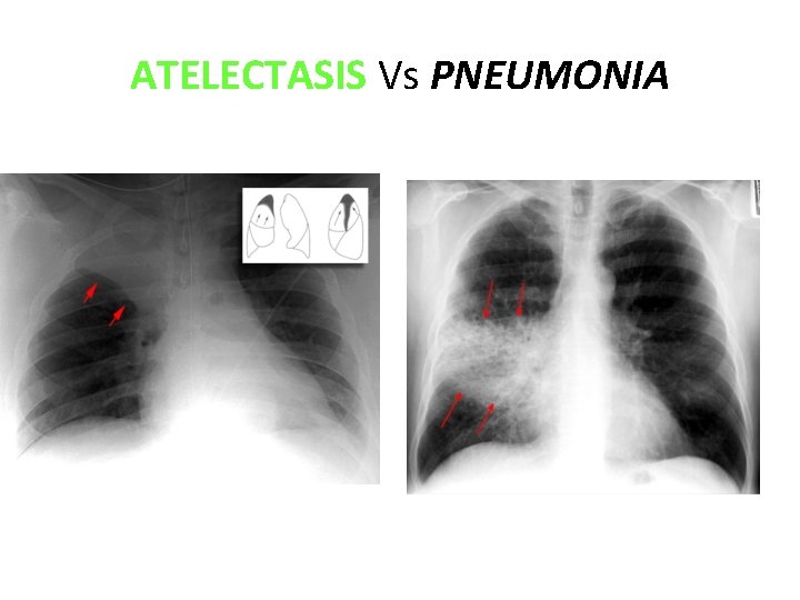 ATELECTASIS Vs PNEUMONIA 