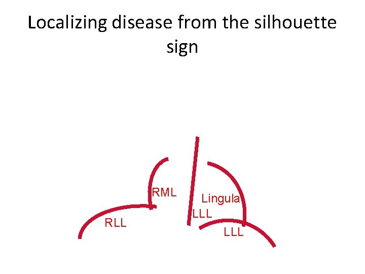 Localizing disease from the silhouette sign RML RLL Lingula LLL 