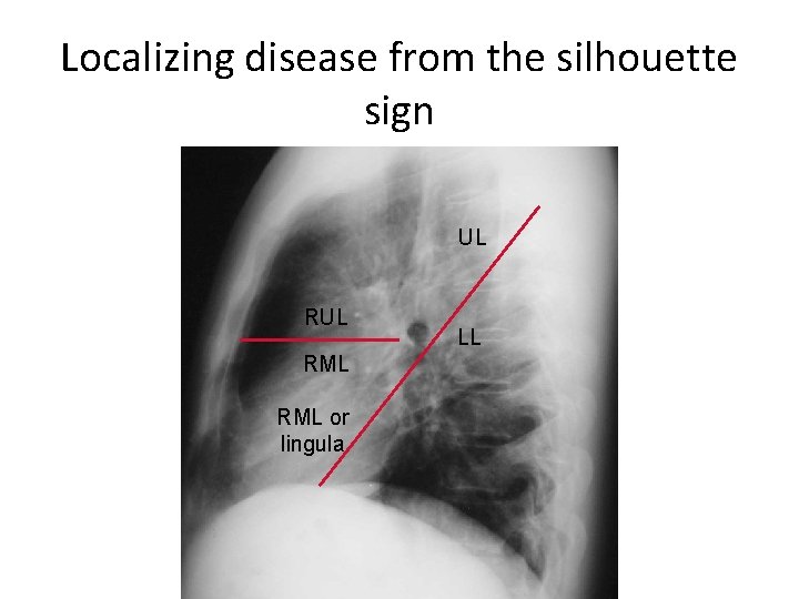 Localizing disease from the silhouette sign UL RML RML or lingula LL 
