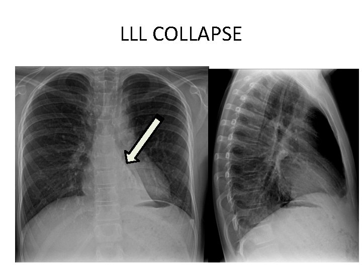 LLL COLLAPSE 