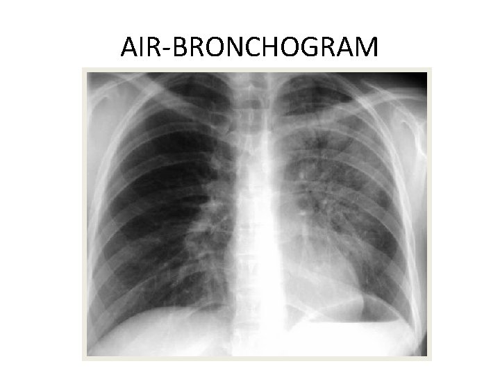 AIR-BRONCHOGRAM 
