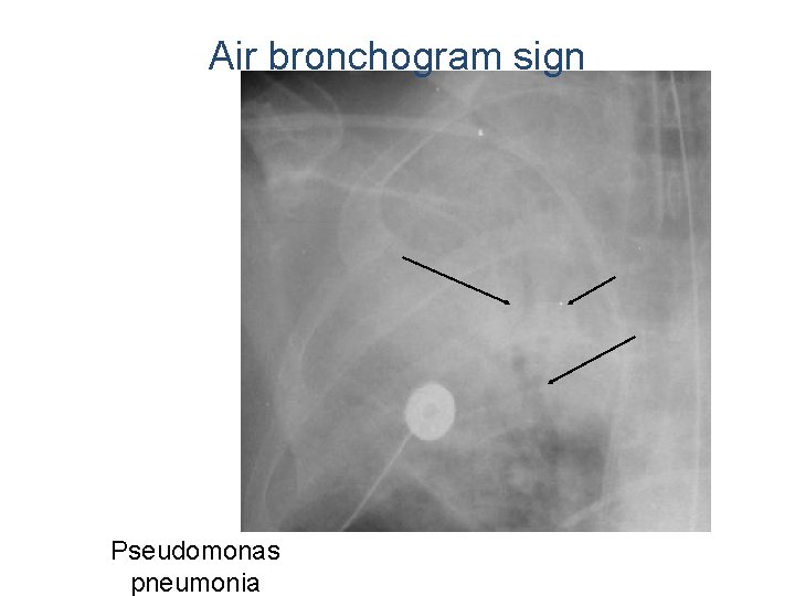 Air bronchogram sign Pseudomonas pneumonia 
