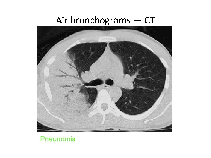 Air bronchograms — CT Pneumonia 