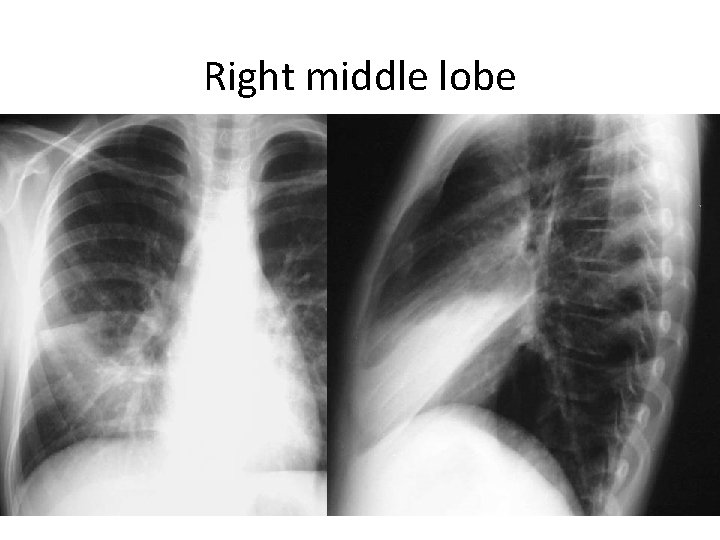 Right middle lobe 