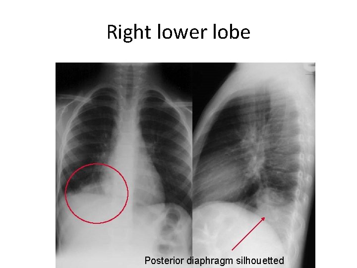 Right lower lobe Posterior diaphragm silhouetted 