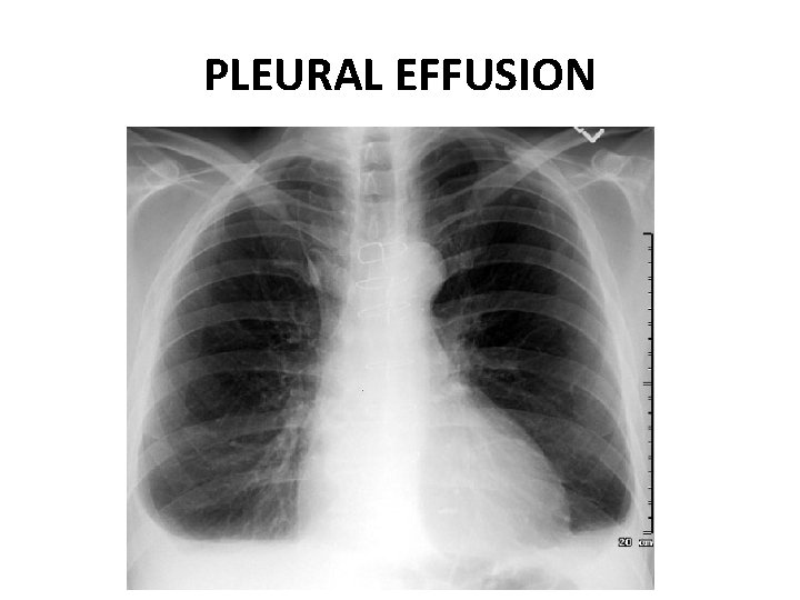 PLEURAL EFFUSION 