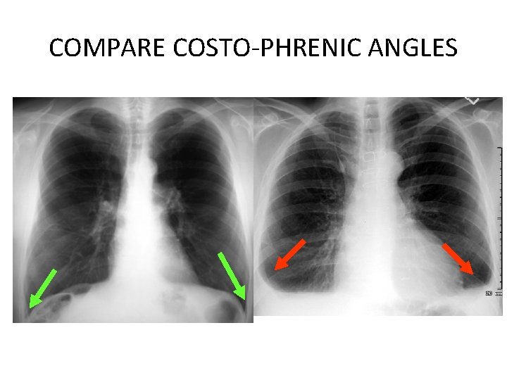 COMPARE COSTO-PHRENIC ANGLES 