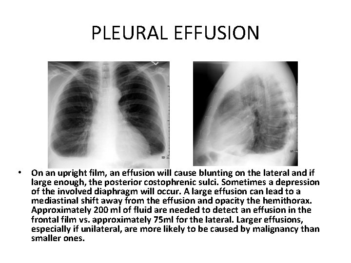 PLEURAL EFFUSION • On an upright film, an effusion will cause blunting on the