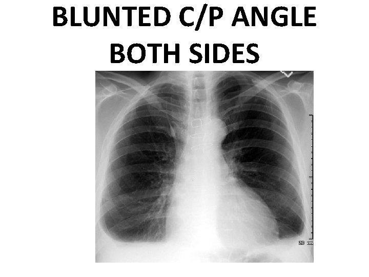 BLUNTED C/P ANGLE BOTH SIDES 