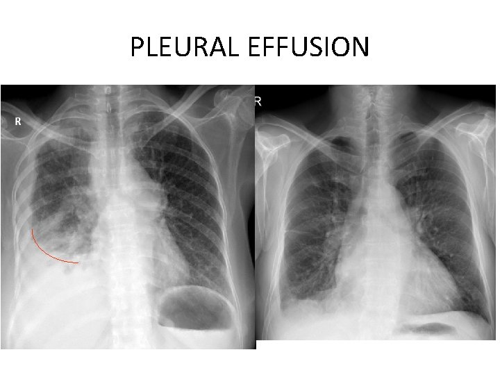 PLEURAL EFFUSION 