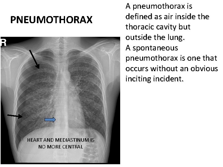 PNEUMOTHORAX HEART AND MEDIASTINUM IS NO MORE CENTRAL A pneumothorax is defined as air