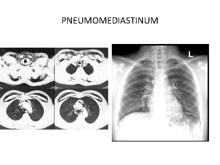 PNEUMOMEDIASTINUM 