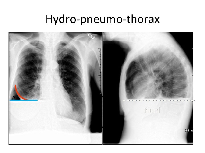 Hydro-pneumo-thorax A Fluid fluid 