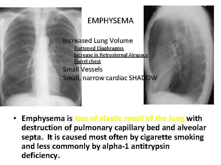 EMPHYSEMA Increased Lung Volume Flattened Diaphragms Increase in Retrosternal Airspace Barrel chest Small Vessels