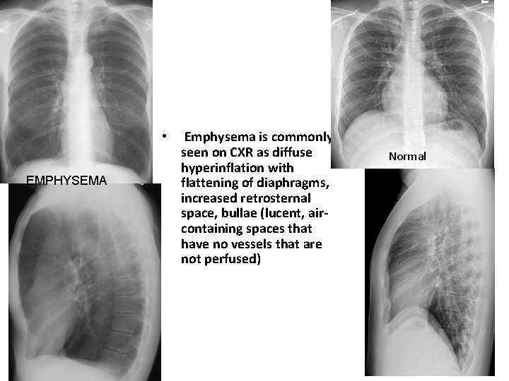  • EMPHYSEMA Emphysema is commonly seen on CXR as diffuse hyperinflation with flattening