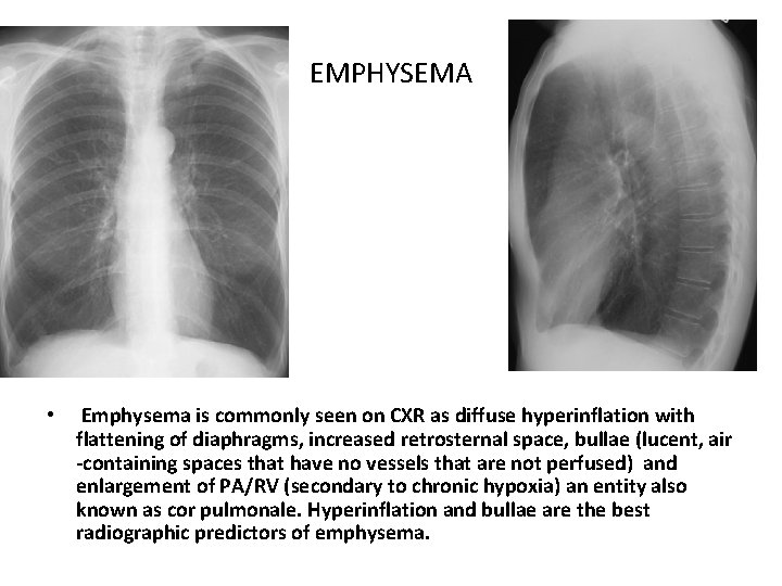 EMPHYSEMA • Emphysema is commonly seen on CXR as diffuse hyperinflation with flattening of
