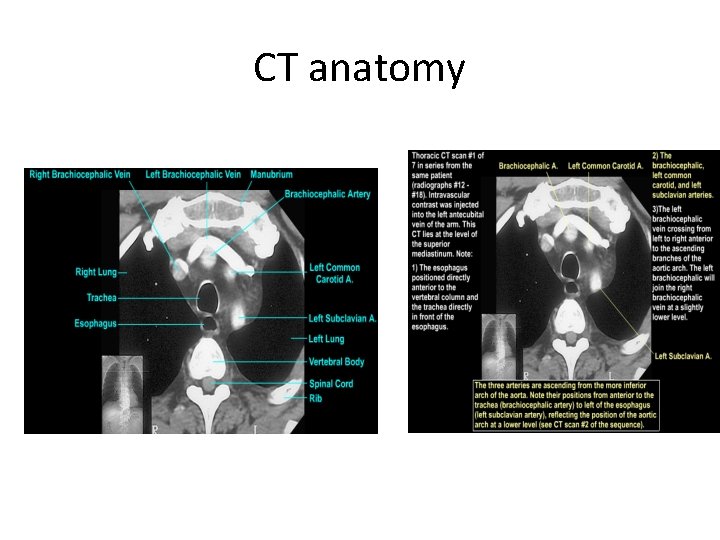 CT anatomy 