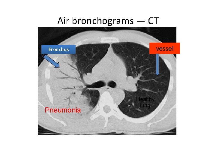 Air bronchograms — CT vessel Bronchus Pneumonia Healthy lung 