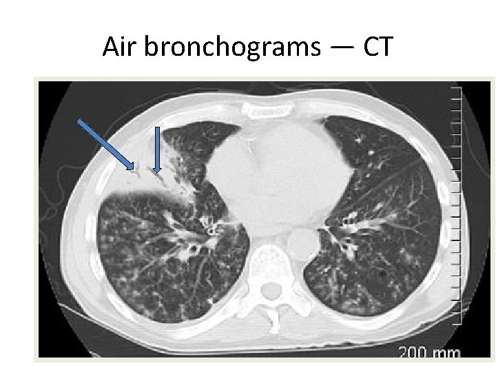 Air bronchograms — CT 