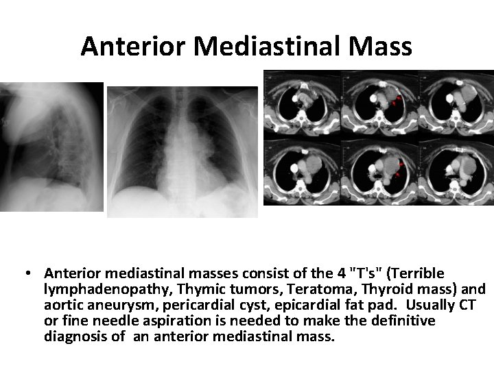 Anterior Mediastinal Mass • Anterior mediastinal masses consist of the 4 "T's" (Terrible lymphadenopathy,