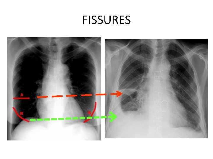 FISSURES 