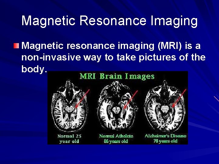 Magnetic Resonance Imaging Magnetic resonance imaging (MRI) is a non-invasive way to take pictures