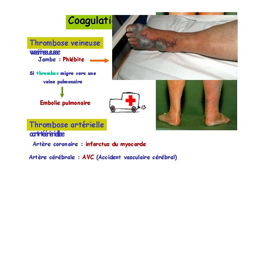 Coagulation excessive Thrombose TThhrorommbboosseeveineuse vveeinineeususee Jambe : Phlébite Si thrombus migre vers une veine