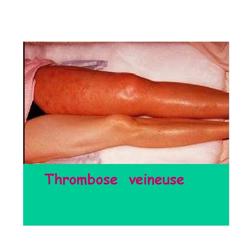 Thrombose veineuse 